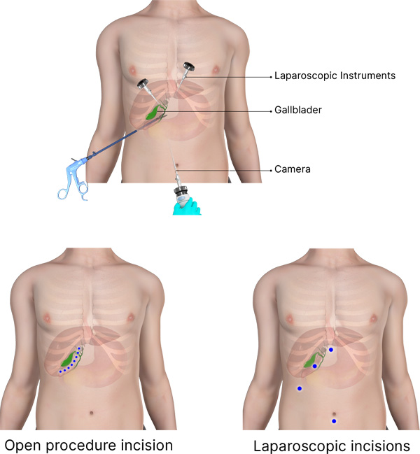 gallbladder pain location